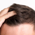 HFE jako nieinwazyjna i skuteczna metoda przeszczepiania włosów